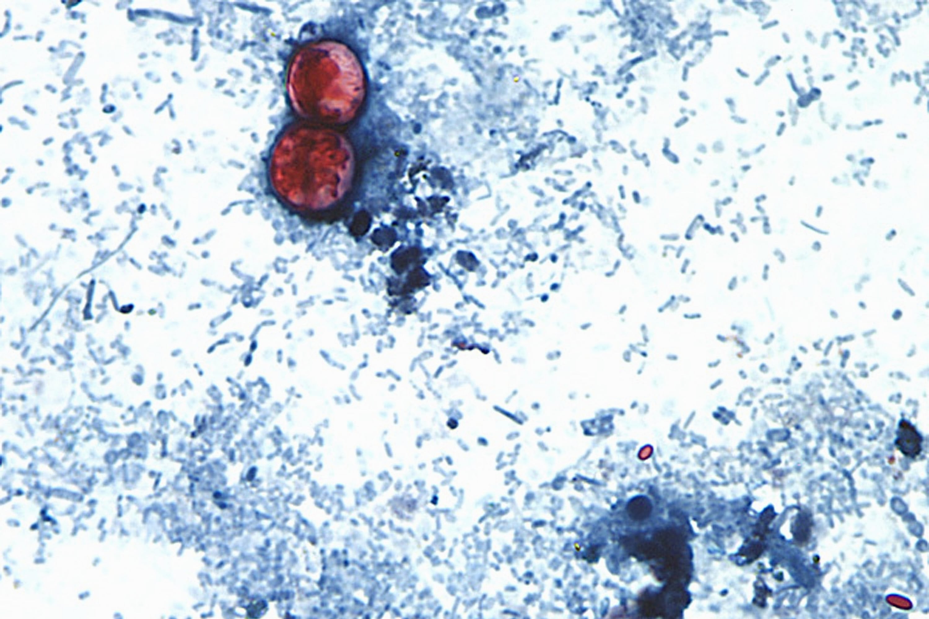 Nashville Food Critic Recovers From Cyclosporiasis Illness