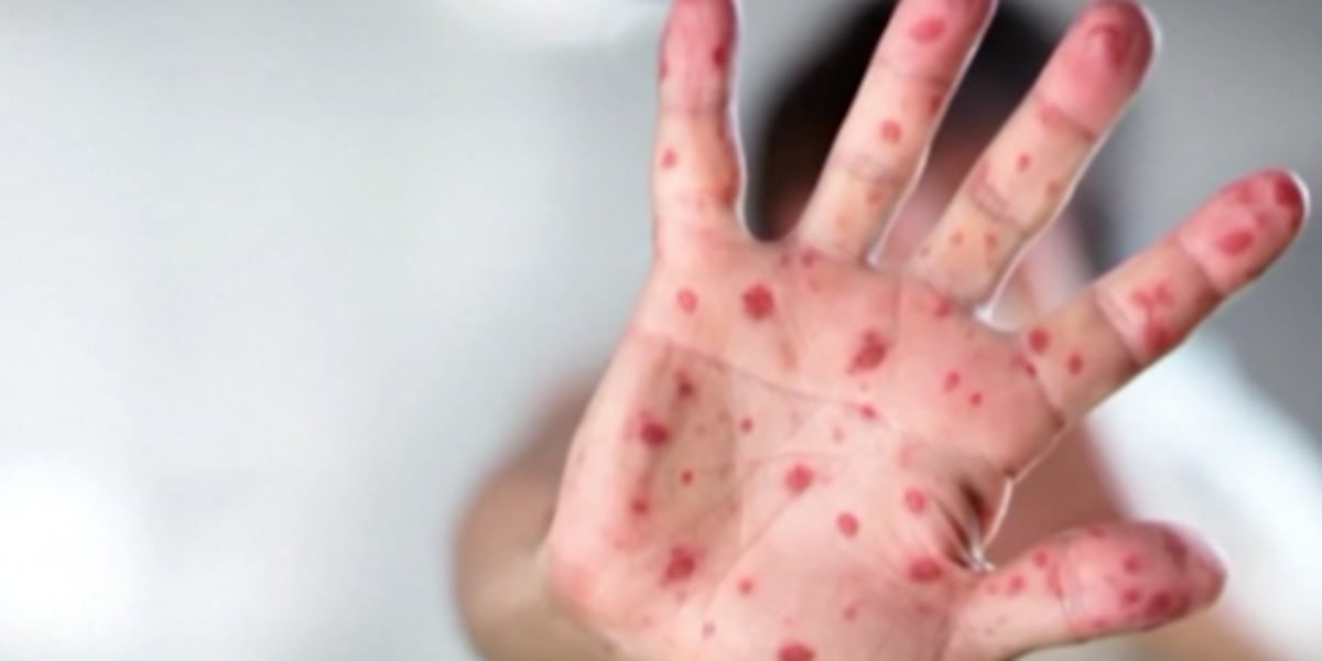 Doctors say ‘mini epidemic’ is possible after measles case confirmed in Middle Tennessee Doctors say ‘mini epidemic’ is possible after measles case confirmed in Middle Tennessee
